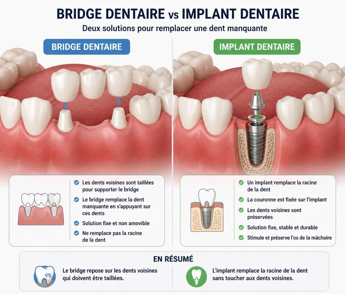 découvrez tout ce qu'il faut savoir sur le bridge dentaire : définition, avantages, procédure et entretien pour un sourire éclatant.