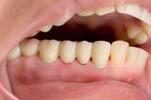 découvrez tout ce qu'il faut savoir sur le bridge dentaire : types, pose, entretien et conseils pour un sourire éclatant. guide complet pour bien choisir et entretenir votre bridge.