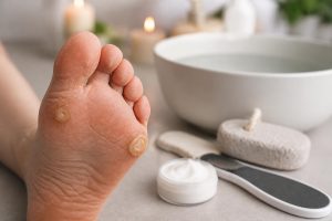 découvrez comment identifier et soigner efficacement les cors au pied et les durillons grâce à nos conseils pratiques pour soulager la douleur et prévenir leur récidive.