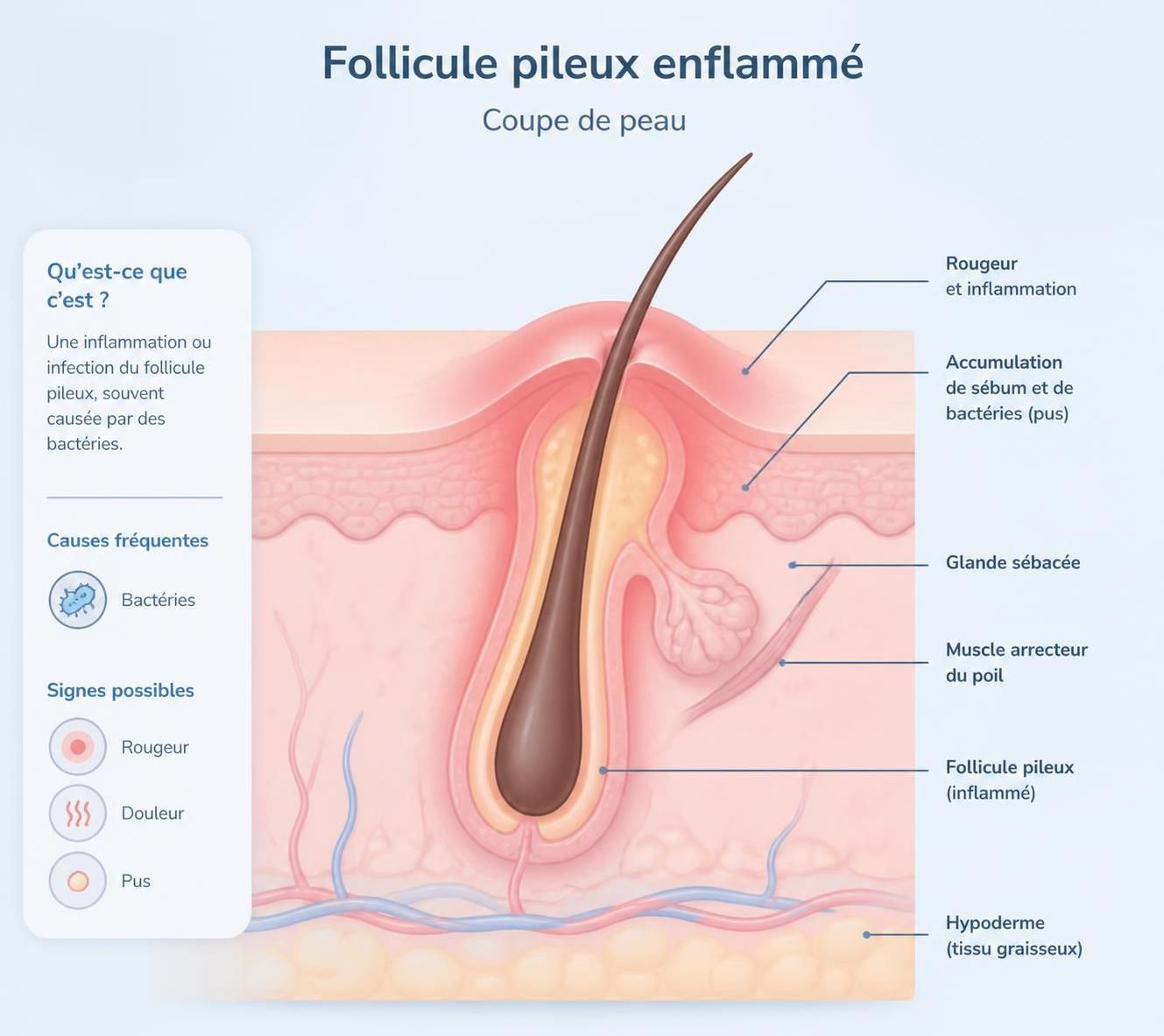 découvrez comment soigner un furoncle fessier efficacement avec nos conseils pratiques pour soulager la douleur et accélérer la guérison.