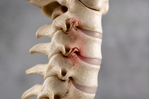 découvrez ce qu'est l'uncarthrose cervicale, ses causes, symptômes et traitements pour mieux comprendre cette pathologie qui affecte la colonne cervicale.
